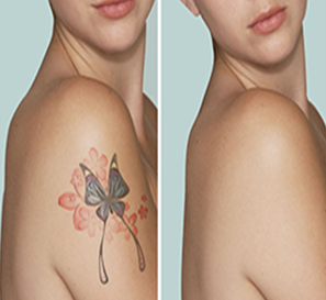 HOW TO REMOVE TATTOO WITH SALINE